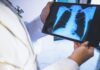 SSM apelam a rastreio a trabalhadores não-residentes por ocasião do Dia Mundial da Tuberculose