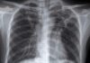 Tuberculose em Macau continua superior à meta de eliminação definida pela OMS